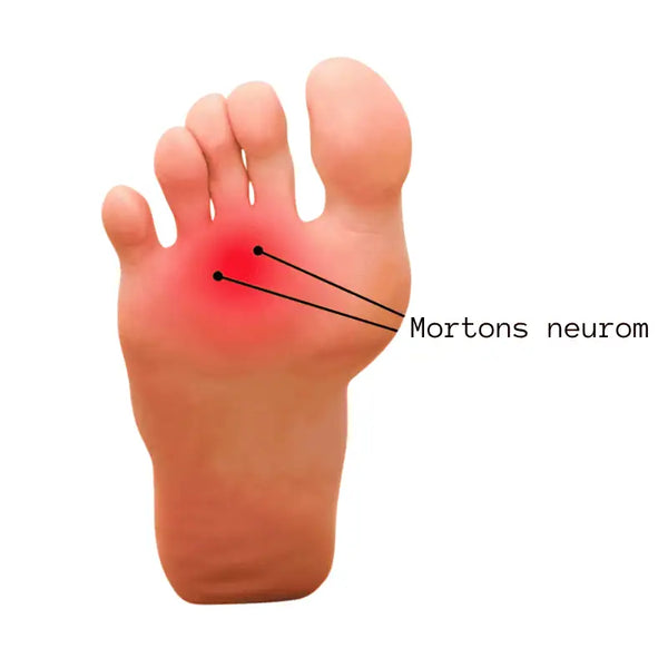 Morton-neuroom